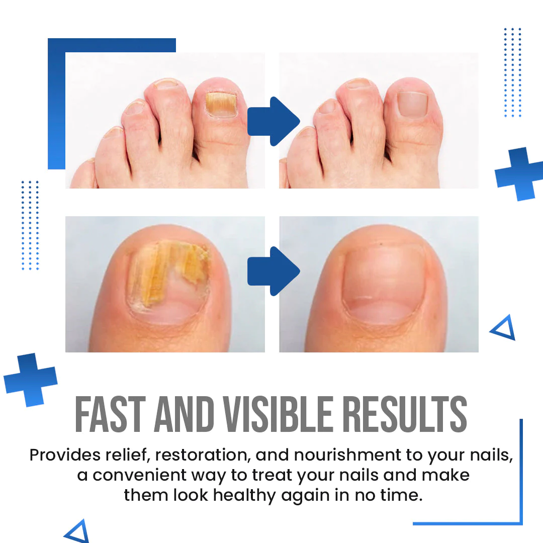 BioLab Anti Fungus Blue Light Laser Pen