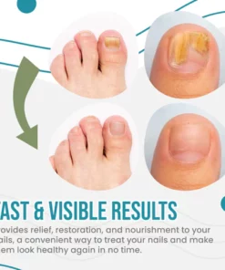 NailSpeed Laser Light Fungal Nail Pen