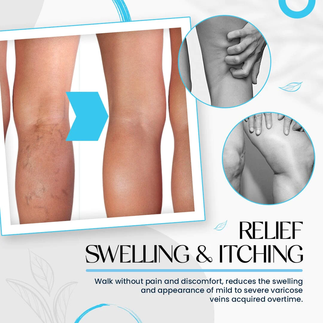 Raura Varicose Veins Treatment Cream