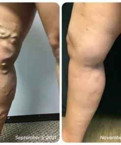 Oveallgo VeinLess Immediate Relief Herbal Patch