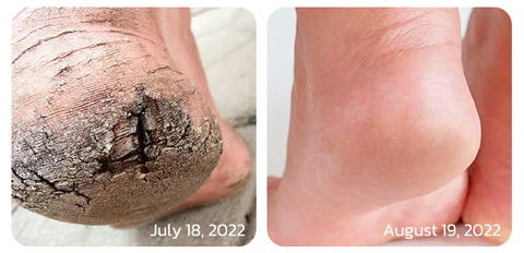 GFOUK IHerbal Foot Callus And Corns Removal Soak