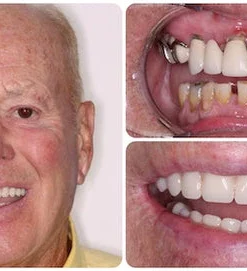 Shark Cartilage Protein & Hydrated Silica Dental Restoration Gel