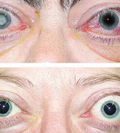 AAFQ Natural Plus Herbal Eye Drops with Nano Ultrasonic Spray Eye Moisturizer- Made in USA