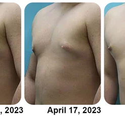 Ricpind MenGynecomastia Infrared Compression T-Shirt