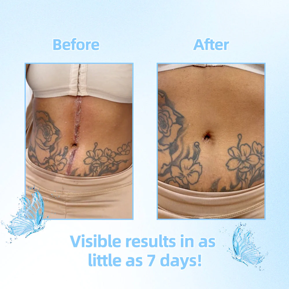 ScarFree Professional Advanced Cool Scar Treatment