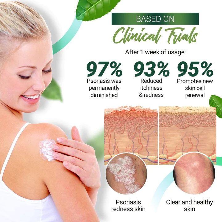 Psoriasis Relieving Cream