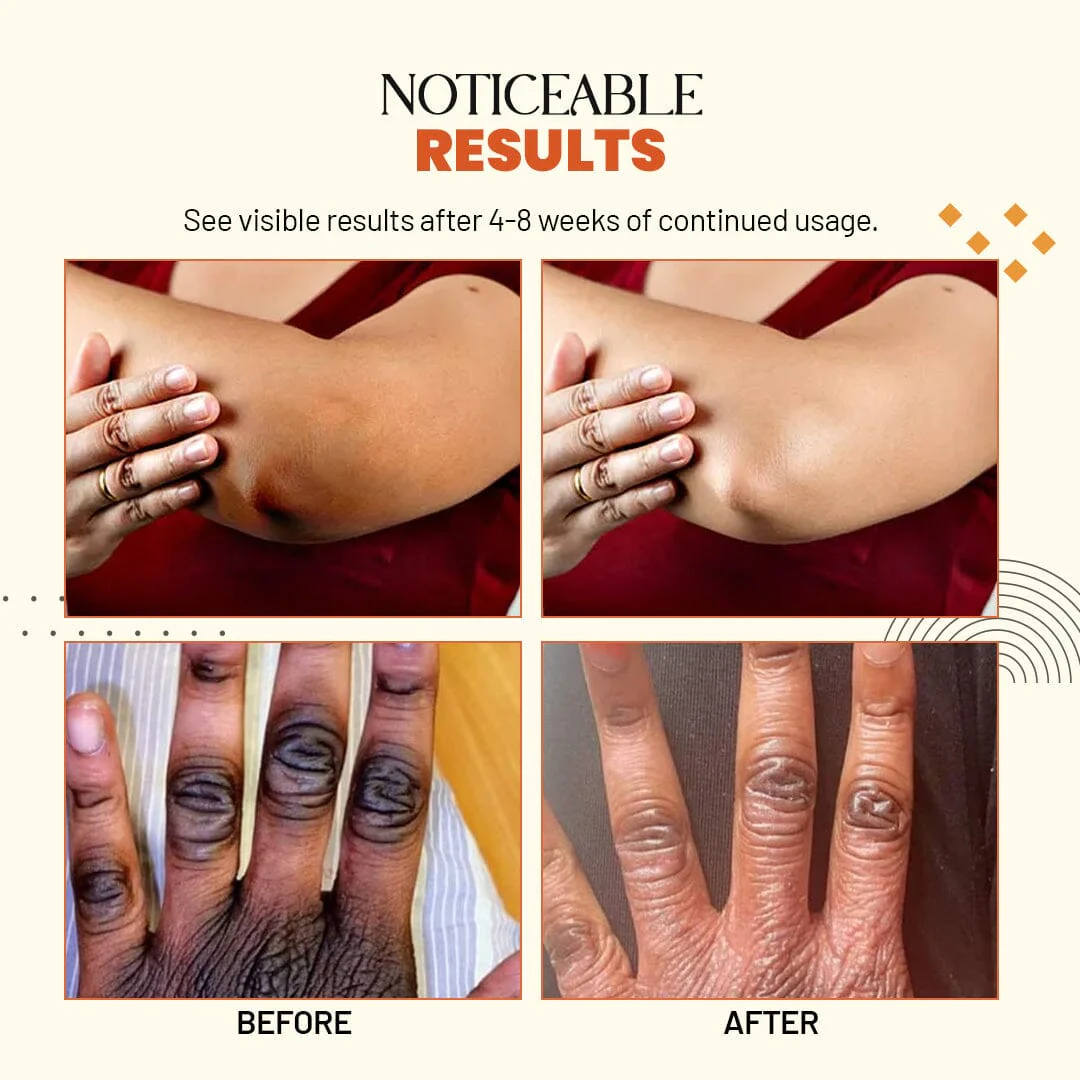 Zakdavi Acanthosis Nigricans Therapy Oil