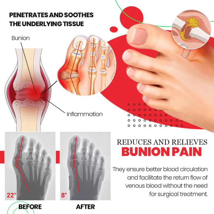ToeAlign Bunion Cream & Corrector Set