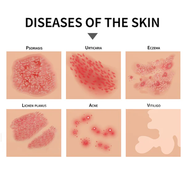 PsoriaGone Psoriasis Relief Spray