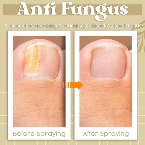Anti Fungal Spray