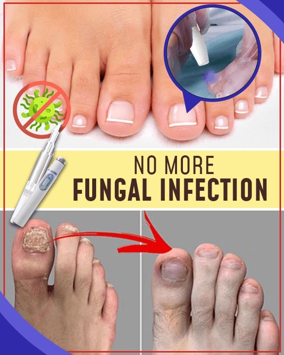 Fungal-out Blue Light Treatment Set