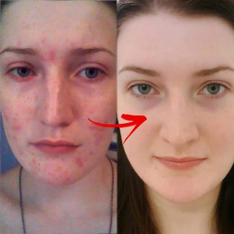 SpotOff Facial Treatment Cream