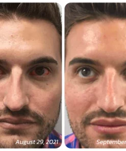 GFOUK OphthlaMed Vision Enhance Roller