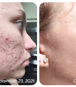 flysmus PockmarksHeal Hyaluronic Acid Microdart Roller