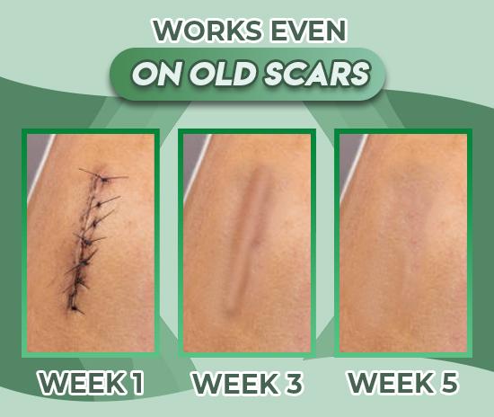 Reusable Surgery Scar Removal Silicone Gel