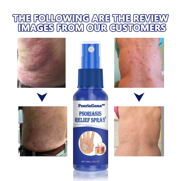 PsoriaGone Psoriasis Relief Spray