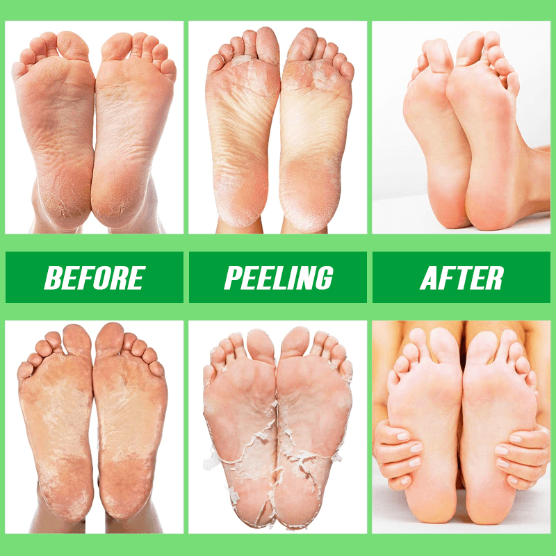 PurePeel Moisturizing Foot Mask