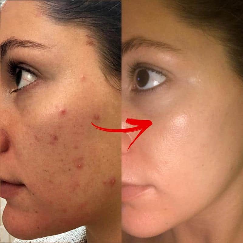 SpotOff Facial Treatment Cream