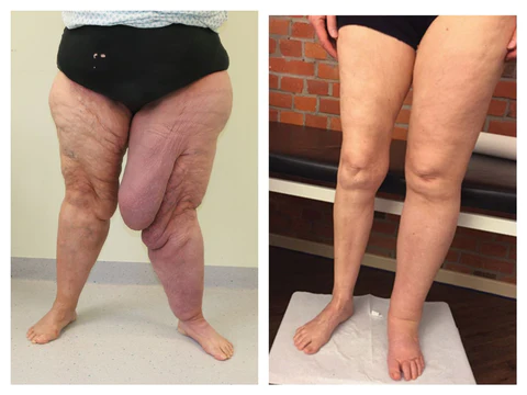 MedMax PRO Kidney Care Patch