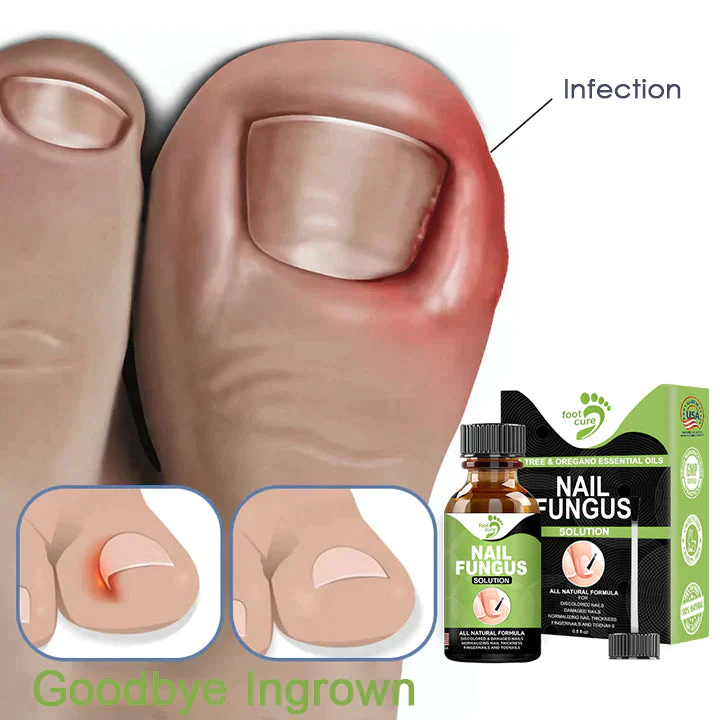 Fivfivgo FootCure Removal Paronychia Gel