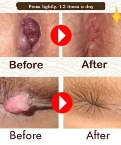 HealHem Herbal Hemorrhoids Anal Capsules