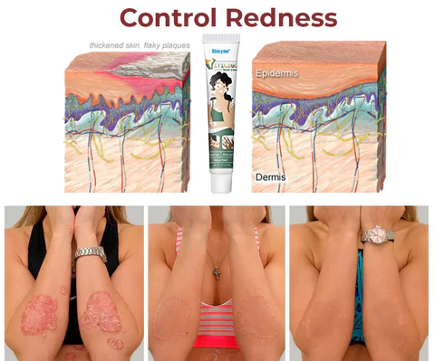 Shinyme Vitiligo Skin Repair Cream