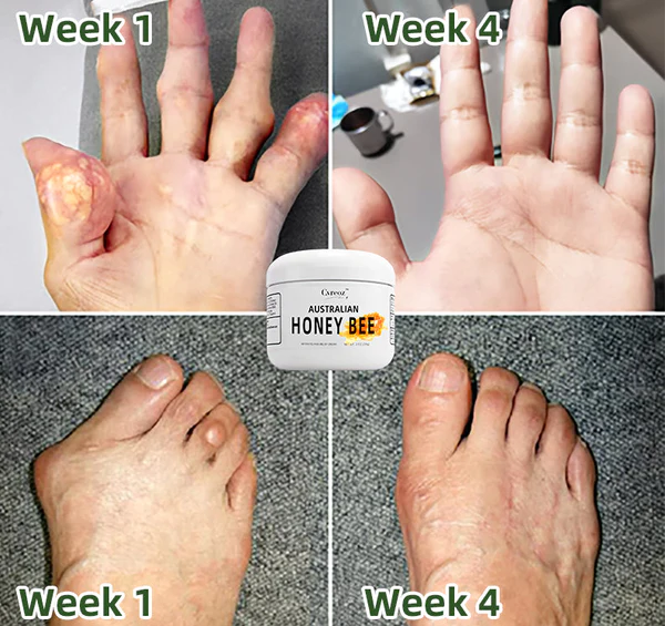 Cvreoz Australian Honey Bee Venom Pain and Bone Healing Cream