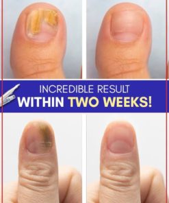 Anti-Fungal Blue Light Treatment Sets