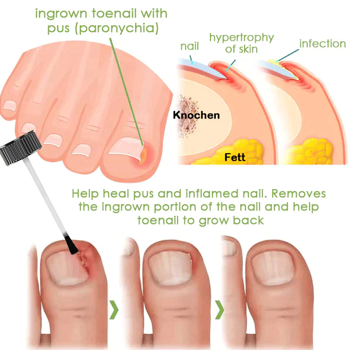 Fivfivgo FootCure Removal Paronychia Gel