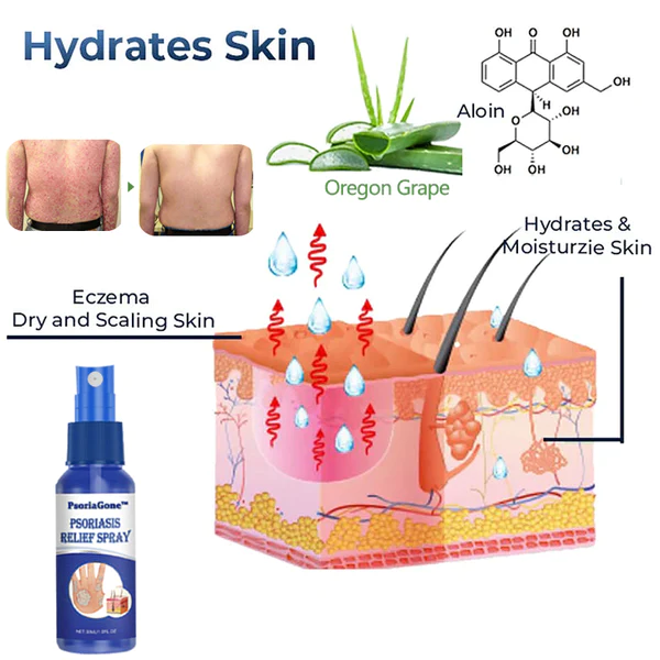 PsoriaGone Psoriasis Relief Spray