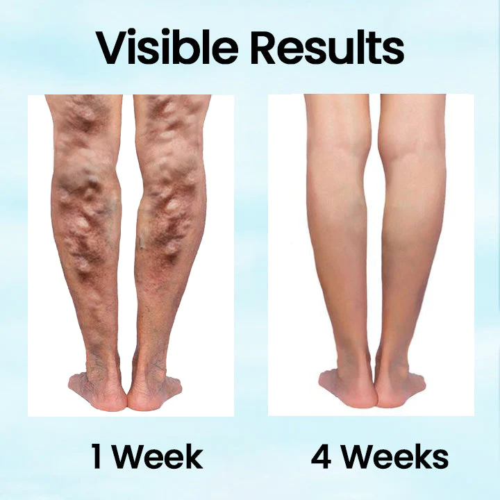 Ceoerty VeinMist Varicose Vein Spray