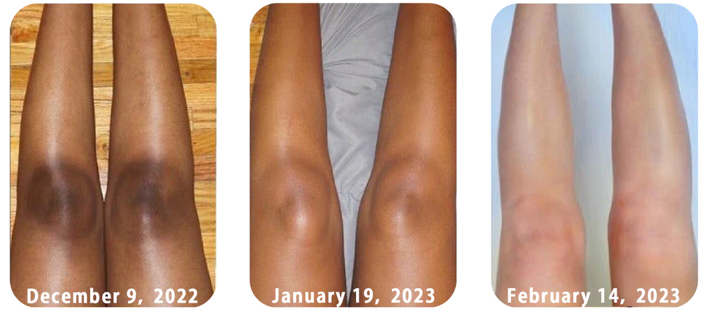 GFOUK AcanthoGlow Therapy Cream