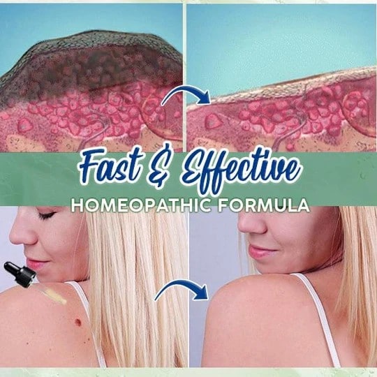 ActiveSkin Mole Removal Serum