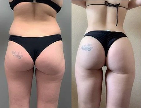 Furzero Backside Lifting & Shaping Cream