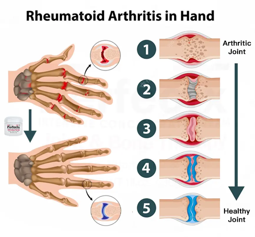 Perfectx Joint & Bone Therapy Cream