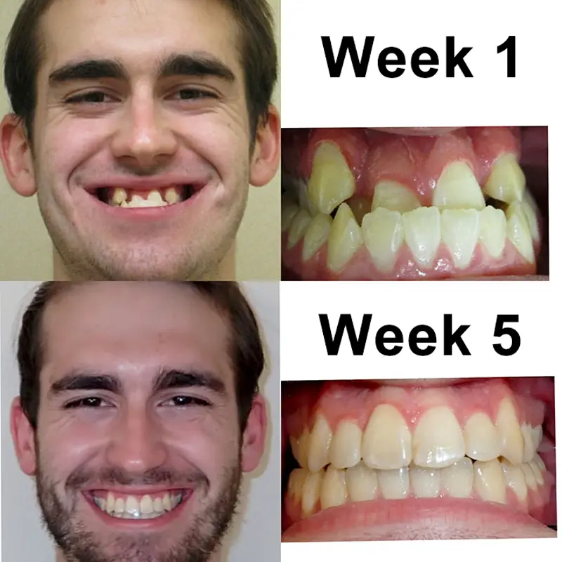 Angelsmile High-Energy Visible(HEV) Teeth Therapy Instrument