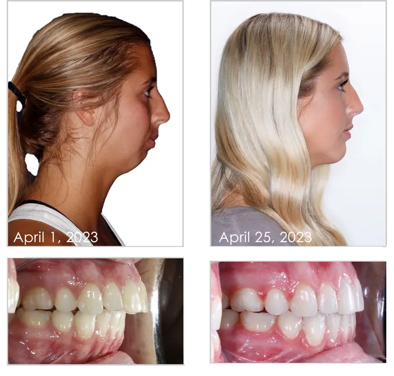 Angelsmile High-Energy Visible(HEV) Teeth Therapy Instrument