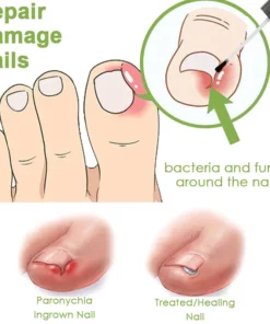 Fivfivgo FootCure Removal Paronychia Gel