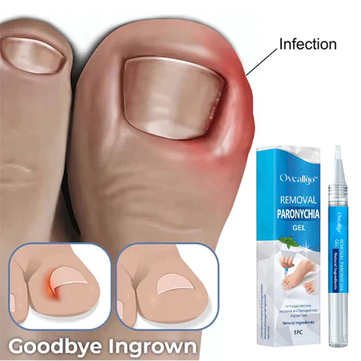 Oveallgo Removal Paronychia Gel