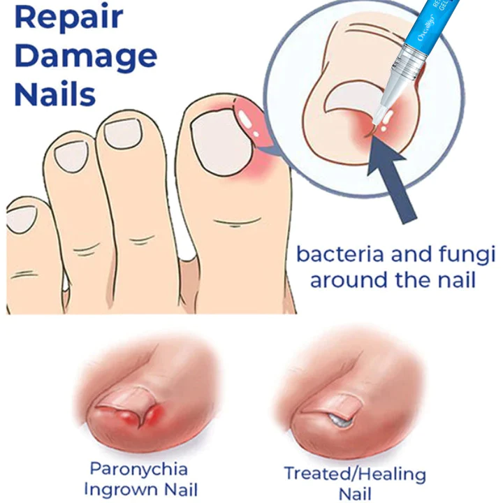 Oveallgo Removal Paronychia Gel