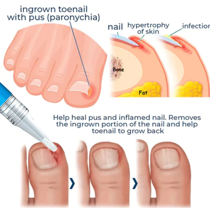 Oveallgo Removal Paronychia Gel