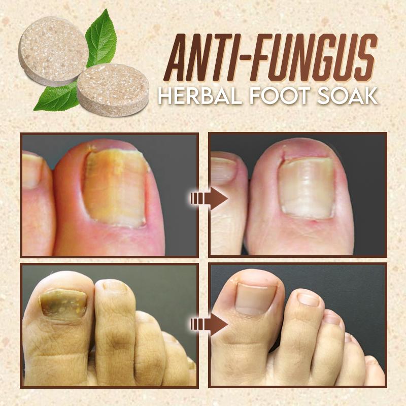 Anti-Fungal Herbal Foot Soak