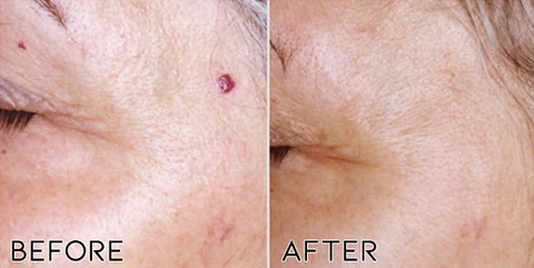 Oveallgo Clearasil Petechiae Removal Cream