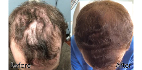 ReACT Minoxi Roll-On Hair Treatment