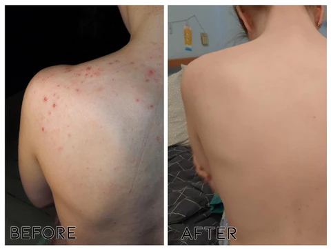 Fivfivgo BackBeautify Body Acne Killer