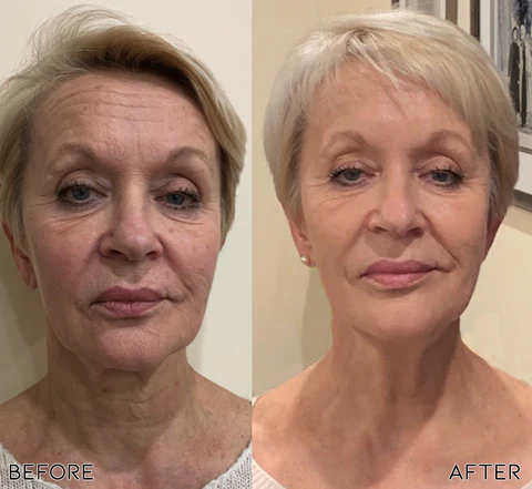 NewBornSkin MicroInfusion Needling System