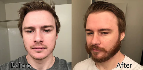 ReACT Minoxi Roll-On Hair Treatment