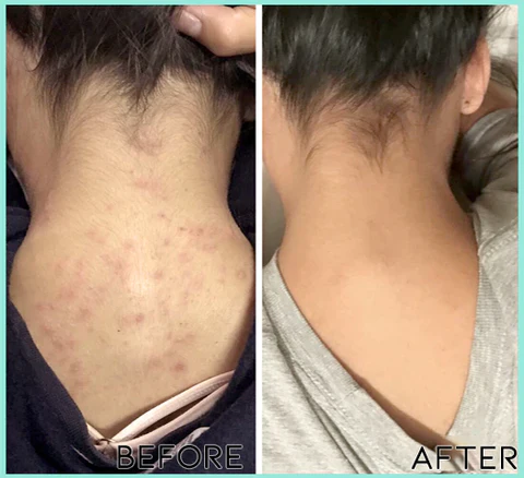 Fivfivgo BackBeautify Body Acne Killer