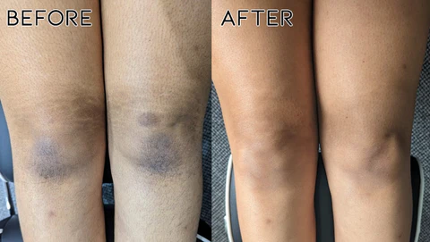 Fivfivgo Acanthosis Nigricans Therapy Oil