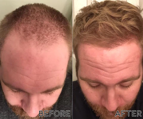ScalpRevive Minoxidil Growth Roller